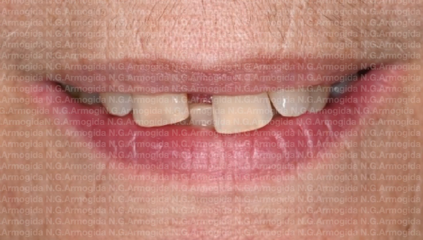 Denti che si muovono o si spostano: si possono salvare?